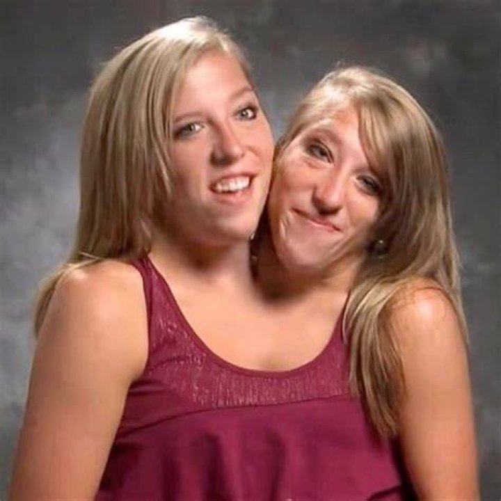 Abby & Brittany Conjoined Twin Abby Hensel Is Married