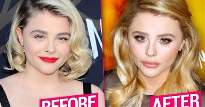 Chlo&euml; Grace Moretz Plastic Surgery Speculation Nose Job & Lip Fillers