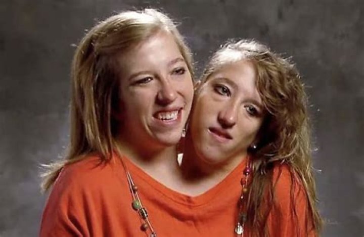 Conjoined twins Abby and Brittany face new twist in marriage to nurse