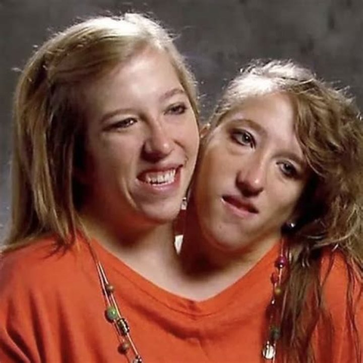 Conjoined Twins Abby & Brittany Hensel Now Their Careers, Health