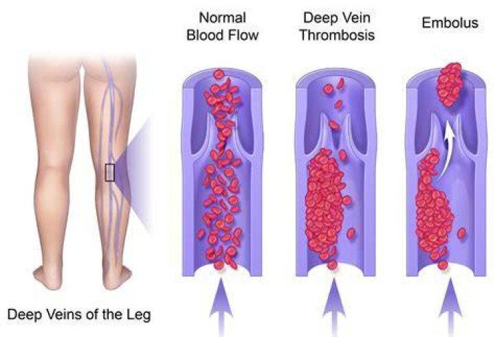 Deep vein thrombosis Wikiwand