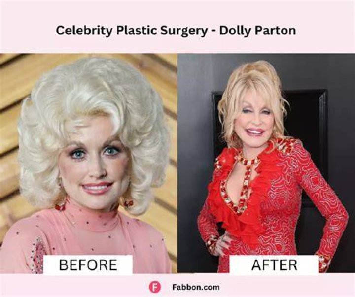 Dolly Parton Plastic Surgery Breast increase, Eyelid Surgery, Nose Job