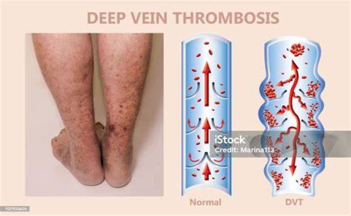 Foto Trombosis Vena Dalam (DVT)