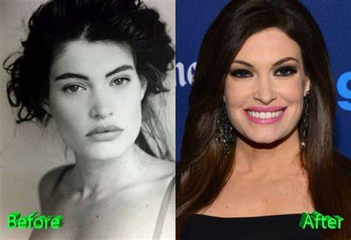 Kimberly Guilfoyle Plastic Surgery Facelift, breast augmentation