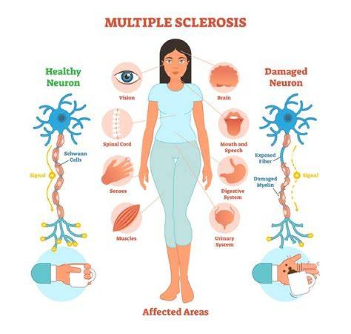 multiple sclerosis — Chronic Care Exercise Physiology Services