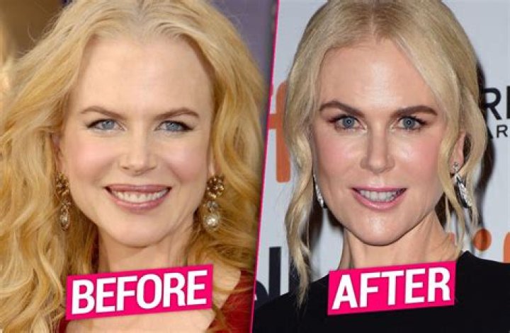 Nicole Kidman plastic surgery for puffy look