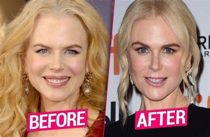 Nicole Kidman Plastic Surgery Photo Details