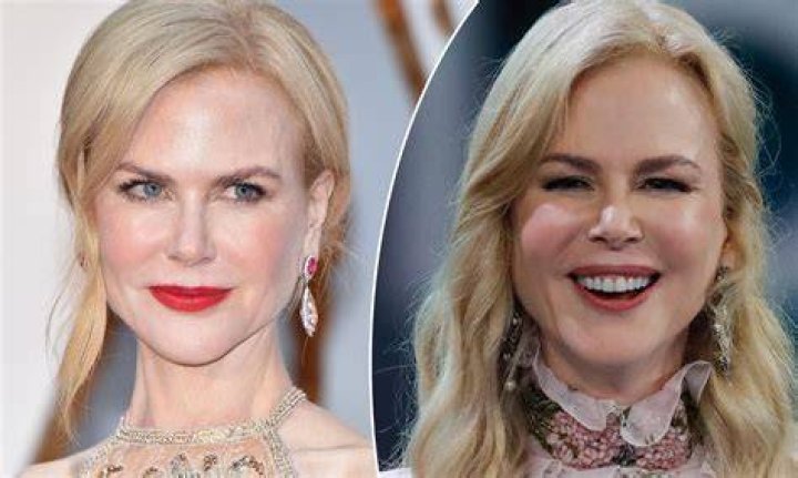 NOcole Kidman puffy cheeks Dr