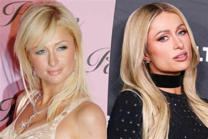 Paris Hilton Has Never Had Plastic Surgery or Botox 'I've Always Been