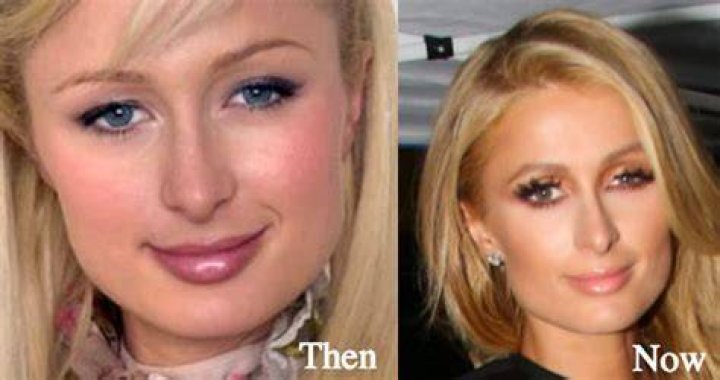 Paris Hilton Plastic Surgery Before and After Pictures 2024