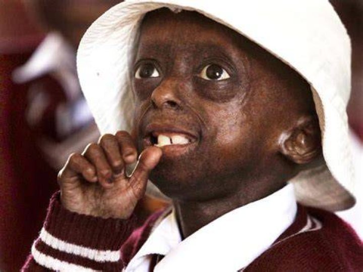 Progeria First black child with rare aging disease Photo 14