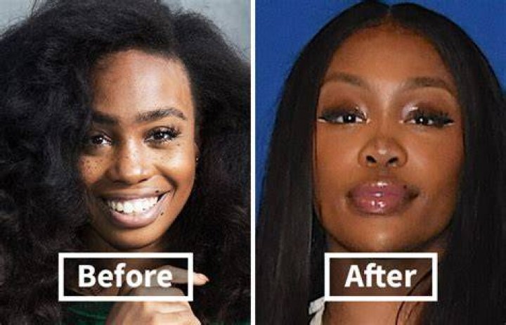 SZA&rsquo;S BEFORE AND AFTER SURGICAL SHOWCASE AN EVOLUTIONARY TALE! Celeb