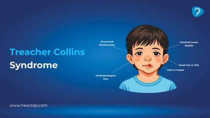 Síndrome de Treacher Collins todo sobre la enfermedad que hizo visible