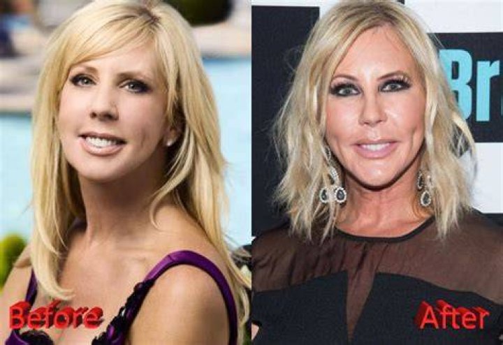 Vicki Dortch Age, Plastic Surgery, Wlky, Eyes, Husband