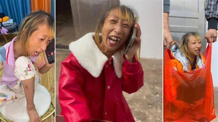 Xiao Xiao Disability, AVM Explained And Journey With Microcephaly